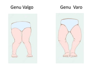 Genu Valgo Genu Varo
 
