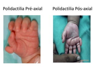 Polidactilia Pré-axial Polidactilia Pós-axial
 