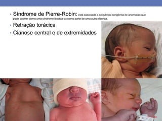 • Síndrome de Pierre-Robin: está associada a sequência congênita de anomalias que
pode ocorrer como uma síndrome isolada ou como parte de uma outra doença.
• Retração torácica
• Cianose central e de extremidades
 