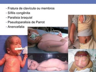 • Fratura de clavícula ou membros
• Sífilis congênita
• Paralisia braquial
• Pseudoparalisia de Parrot
• Anencefalia
 