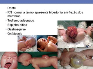 • Dente
• RN normal a termo apresenta hipertonia em flexão dos
membros
• Trofismo adequado
• Espinha bífida
• Gastrosquise
• Onfalocele
 