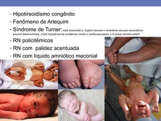 • Hipotireoidismo congênito
• Fenômeno de Arlequim
• Síndrome de Turner:está associada a, órgãos sexuais e caracteres sexuais secundários
poucos desenvolvidos, maior frequência de problemas renais e cardiovasculares, e é quase sempre estéril .
• RN policitêmicos
• RN com palidez acentuada
• RN com líquido amniótico meconial
 