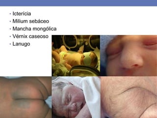 • Icterícia
• Milium sebáceo
• Mancha mongólica
• Vérnix caseoso
• Lanugo
 