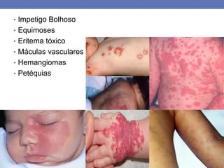 • Impetigo Bolhoso
• Equimoses
• Eritema tóxico
• Máculas vasculares
• Hemangiomas
• Petéquias
 