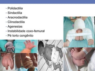 • Polidactilia
• Sindactilia
• Aracnodactilia
• Clinodactilia
• Agenesias
• Instabilidade coxo-femural
• Pé torto congênito
 