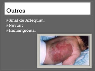Outros
⦿Sinal de Arlequim;
⦿Nevus ;
⦿Hemangioma;
 