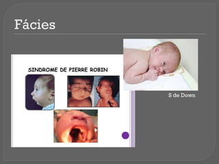 Fácies
S de Down
 