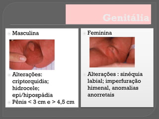 Genitália
⦿ Masculina
⦿ Alterações:
criptorquidia;
hidrocele;
epi/hipospádia
⦿ Pênis < 3 cm e > 4,5 cm
⦿ Feminina
⦿ Alterações : sinéquia
labial; imperfuração
himenal, anomalias
anorretais
 