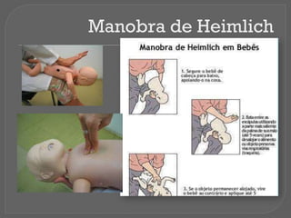 Manobra de Heimlich
 
