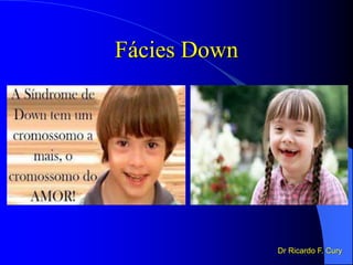 Fácies Down
Dr Ricardo F. Cury
 