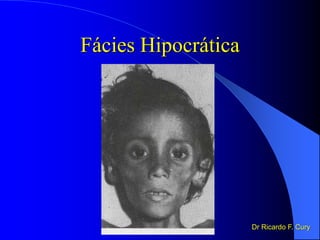 Fácies Hipocrática
Dr Ricardo F. Cury
 