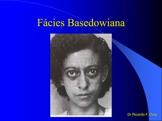Fácies Basedowiana
Dr Ricardo F. Cury
 