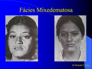 Fácies Mixedematosa
Dr Ricardo F. Cury
 