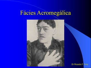 Fácies Acromegálica
Dr Ricardo F. Cury
 