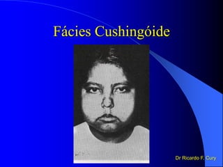 Fácies Cushingóide
Dr Ricardo F. Cury
 