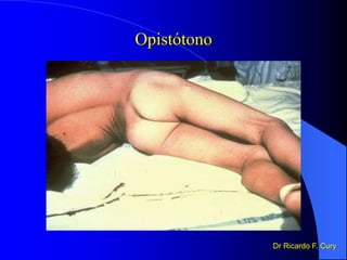 Opistótono
Dr Ricardo F. Cury
 