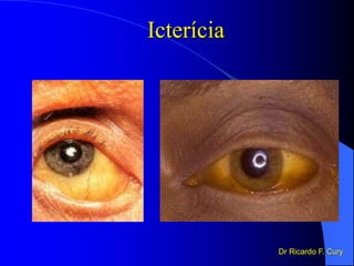 Icterícia
Dr Ricardo F. Cury
 