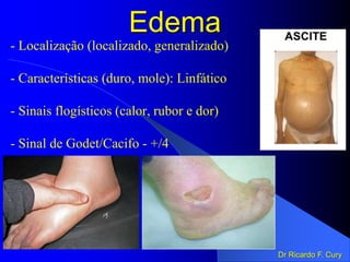 Edema
- Localização (localizado, generalizado)
- Características (duro, mole): Linfático
- Sinais flogísticos (calor, rubor e dor)
- Sinal de Godet/Cacifo - +/4
Dr Ricardo F. Cury
 