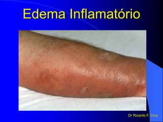 Edema Inflamatório
Dr Ricardo F. Cury
 