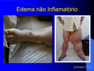Edema não Inflamatório
Dr Ricardo F. Cury
 