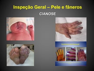 Inspeção Geral – Pele e fâneros
CIANOSECIANOSE
 