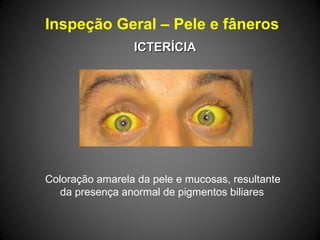 Inspeção Geral – Pele e fâneros
ICTERÍCIAICTERÍCIA
 Coloração amarela da pele e mucosas, resultante  
      da presença anormal de pigmentos biliares
 