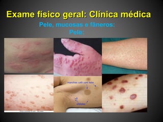 Exame físico geral: Clínica médicaExame físico geral: Clínica médica
Pele, mucosas e fâneros:
Pele:
 