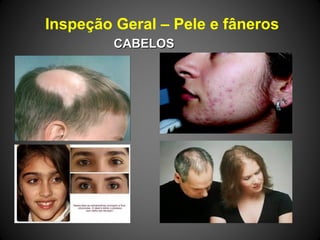 Inspeção Geral – Pele e fâneros
CABELOSCABELOS
 