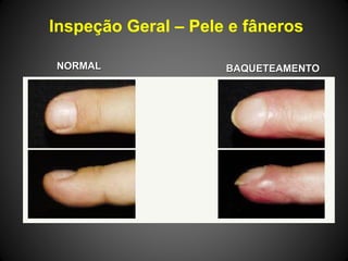 Inspeção Geral – Pele e fâneros
NORMALNORMAL BAQUETEAMENTOBAQUETEAMENTO
 