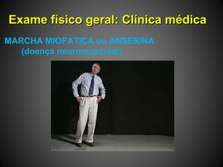 Exame físico geral: Clínica médicaExame físico geral: Clínica médica
MARCHA MIOPATICA ou ANSERINA
(doença neuromuscular)
 