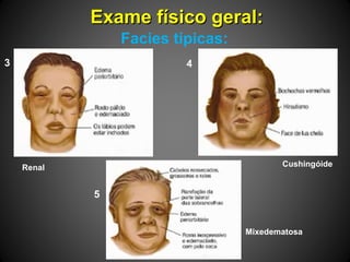 Exame físico geral:Exame físico geral:
Facies típicas:
4
5
3
Cushingóide
Mixedematosa
Renal
 