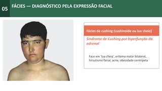 05
FÁCIES — DIAGNÓSTICO PELA EXPRESSÃO FACIAL
Fácies de cushing (cushinoide ou lua cheia)
S
Síndrome de Cushing por hiperfunção da
adrenal
Face em 'lua cheia', eritema malar bilateral,
hirsutismo facial, acne, obesidade centrípeta
 