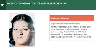 05
FÁCIES — DIAGNÓSTICO PELA EXPRESSÃO FACIAL
Fácies mixedematosa
Hipotireoidismo ou mixedema
Rosto arredondado, nariz e lábios grossos, pele
seca, espessada e com acentuação de seus
sulcos. As pálpebras tornam-se infiltradas e
enrugadas. Os supercílios são escassos e os
cabelos secos e sem brilho + desânimo e apatia
 