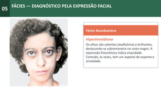 05
FÁCIES — DIAGNÓSTICO PELA EXPRESSÃO FACIAL
Fácies Basedowiana
Hipertireoidismo
Os olhos são salientes (exoftalmia) e brilhantes,
destacando-se sobremaneira no rosto magro. A
expressão fisionômica indica vivacidade.
Contudo, às vezes, tem um aspecto de espanto e
ansiedade.
 