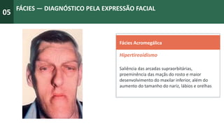 05
FÁCIES — DIAGNÓSTICO PELA EXPRESSÃO FACIAL
Fácies Acromegálica
Hipertireoidismo
Saliência das arcadas supraorbitárias,
proeminência das maçãs do rosto e maior
desenvolvimento do maxilar inferior, além do
aumento do tamanho do nariz, lábios e orelhas
 