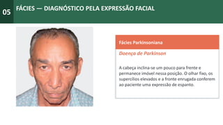 05
FÁCIES — DIAGNÓSTICO PELA EXPRESSÃO FACIAL
Fácies Parkinsoniana
Doença de Parkinson
A cabeça inclina-se um pouco para frente e
permanece imóvel nessa posição. O olhar fixo, os
supercílios elevados e a fronte enrugada conferem
ao paciente uma expressão de espanto.
 