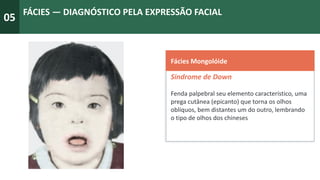 05
FÁCIES — DIAGNÓSTICO PELA EXPRESSÃO FACIAL
Fácies Mongolóide
Sindrome de Down
Fenda palpebral seu elemento característico, uma
prega cutânea (epicanto) que torna os olhos
oblíquos, bem distantes um do outro, lembrando
o tipo de olhos dos chineses
 