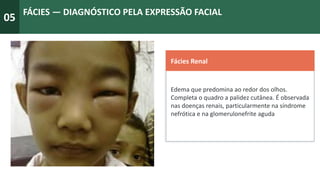 05
FÁCIES — DIAGNÓSTICO PELA EXPRESSÃO FACIAL
Fácies Renal
Edema que predomina ao redor dos olhos.
Completa o quadro a palidez cutânea. É observada
nas doenças renais, particularmente na síndrome
nefrótica e na glomerulonefrite aguda
 