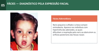 05
FÁCIES — DIAGNÓSTICO PELA EXPRESSÃO FACIAL
Fácies Adenoidiana
Nariz pequeno e afilado e a boca sempre
entreaberta. Aparece nos indivíduos com
hipertrofia das adenoides, as quais
dificultam a respiração pelo nariz ao obstruírem os
orifícios posteriores das fossas nasais
 