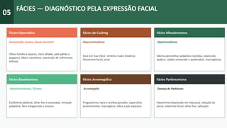05
FÁCIES — DIAGNÓSTICO PELA EXPRESSÃO FACIAL
Fácies Hipocrática
Desnutrição severa; câncer terminal
Olhos fundos e opacos, nariz afilado, pele pálida e
pegajosa, lábios cianóticos, expressão de sofrimento
intenso
Fácies de Cushing
Hipercortisolismo
Face em 'lua cheia', eritema malar bilateral,
hirsutismo facial, acne
Fácies Mixedematosa
Hipotireoidismo
Edema periorbital, pálpebras túmidas, expressão
apática, cabelo ressecado e quebradiço, macroglossia
Fácies Basedowiana
Hipertireoidismo / Graves
Exoftalmia bilateral, olhar fixo e assustado, retração
palpebral, face emagrecida e ansiosa
Fácies Acromegálica
Acromegalia
Prognatismo, nariz e orelhas grandes, supercílios
proeminentes, macroglicia, mãos e pés espessos
Fácies Parkinsoniana
Doença de Parkinson
Hipomimia (expressão em máscara), redução do
piscar, seborreia facial, olhar fixo, salivação
 