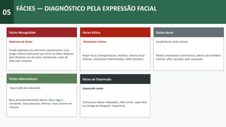 05
FÁCIES — DIAGNÓSTICO PELA EXPRESSÃO FACIAL
Fácies Mongolóide
Sindrome de Down
Fenda palpebral seu elemento característico, uma
prega cutânea (epicanto) que torna os olhos oblíquos,
bem distantes um do outro, lembrando o tipo de
olhos dos chineses
Fácies Etílica
Alcoolismo crônico
Rubor facial, telangiectasias, rinofima, edema facial
matinal, conjuntivas hiperemiadas, hálito alcoólico
Fácies Renal
Insuficiência renal crônica
Palidez amarelada (urochromos), edema periorbitário
matinal, olhar cansado, pele ressecada
Fácies Adenoideana
Hipertrofia de adenoides
Boca permanentemente aberta, olhar vago e
sonolento, nariz pequeno, olheiras, mais comum em
crianças
Fácies de Depressão
Depressão maior
Comissuras labiais rebaixadas, olhar triste, supercílios
em ômega de Veraguth, hipomimia
 
