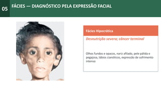 05
FÁCIES — DIAGNÓSTICO PELA EXPRESSÃO FACIAL
Fácies Hipocrática
Desnutrição severa; câncer terminal
Olhos fundos e opacos, nariz afilado, pele pálida e
pegajosa, lábios cianóticos, expressão de sofrimento
intenso
 