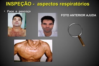 INSPEÇÃO - aspectos respiratóriosINSPEÇÃO - aspectos respiratórios
• Face e pescoçoFace e pescoço
FOTO ANTERIOR AJUDA
 