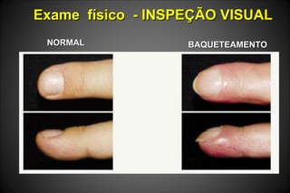 Exame físico - INSPEÇÃO VISUALExame físico - INSPEÇÃO VISUAL
NORMALNORMAL BAQUETEAMENTOBAQUETEAMENTO
 