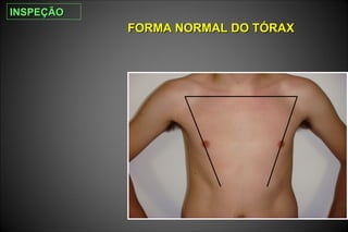 FORMA NORMAL DO TÓRAXFORMA NORMAL DO TÓRAX
INSPEÇÃOINSPEÇÃO
 