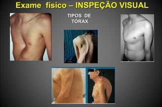 Exame físico – INSPEÇÃO VISUALExame físico – INSPEÇÃO VISUAL
TIPOS DETIPOS DE
TÓRAXTÓRAX
 