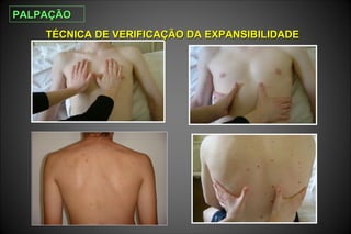 TÉCNICA DE VERIFICAÇÃO DA EXPANSIBILIDADETÉCNICA DE VERIFICAÇÃO DA EXPANSIBILIDADE
PALPAÇÃOPALPAÇÃO
 