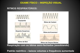 EXAME FÍSICO – INSPEÇÃO VISUAL
RITMOS RESPIRATÓRIOS:
Respiração com os lábios semi-fechados (assobiando)
Padrão restritivo – baixos volumes e frequência aumentada
 