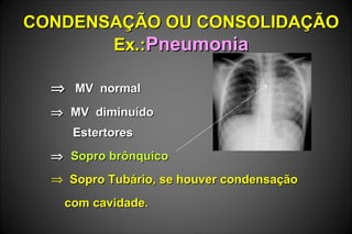 CONDENSAÇÃO OU CONSOLIDAÇÃOCONDENSAÇÃO OU CONSOLIDAÇÃO
Ex.:Ex.:PneumoniaPneumonia
⇒⇒ MV normalMV normal
⇒⇒ MV diminuídoMV diminuído
EstertoresEstertores
⇒⇒ Sopro brônquicoSopro brônquico
⇒ Sopro Tubário, se houver condensaçãoSopro Tubário, se houver condensação
com cavidade.com cavidade.
 