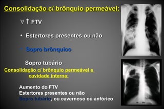 Consolidação c/ brônquio permeável:Consolidação c/ brônquio permeável:
∀ ↑↑ FTVFTV
• Estertores presentes ou nãoEstertores presentes ou não
• Sopro brônquicoSopro brônquico
Sopro tubárioSopro tubário
Consolidação c/ brônquio permeável e
cavidade interna:
Aumento do FTV
Estertores presentes ou não
Sopro tubário, ou cavernoso ou anfórico
 